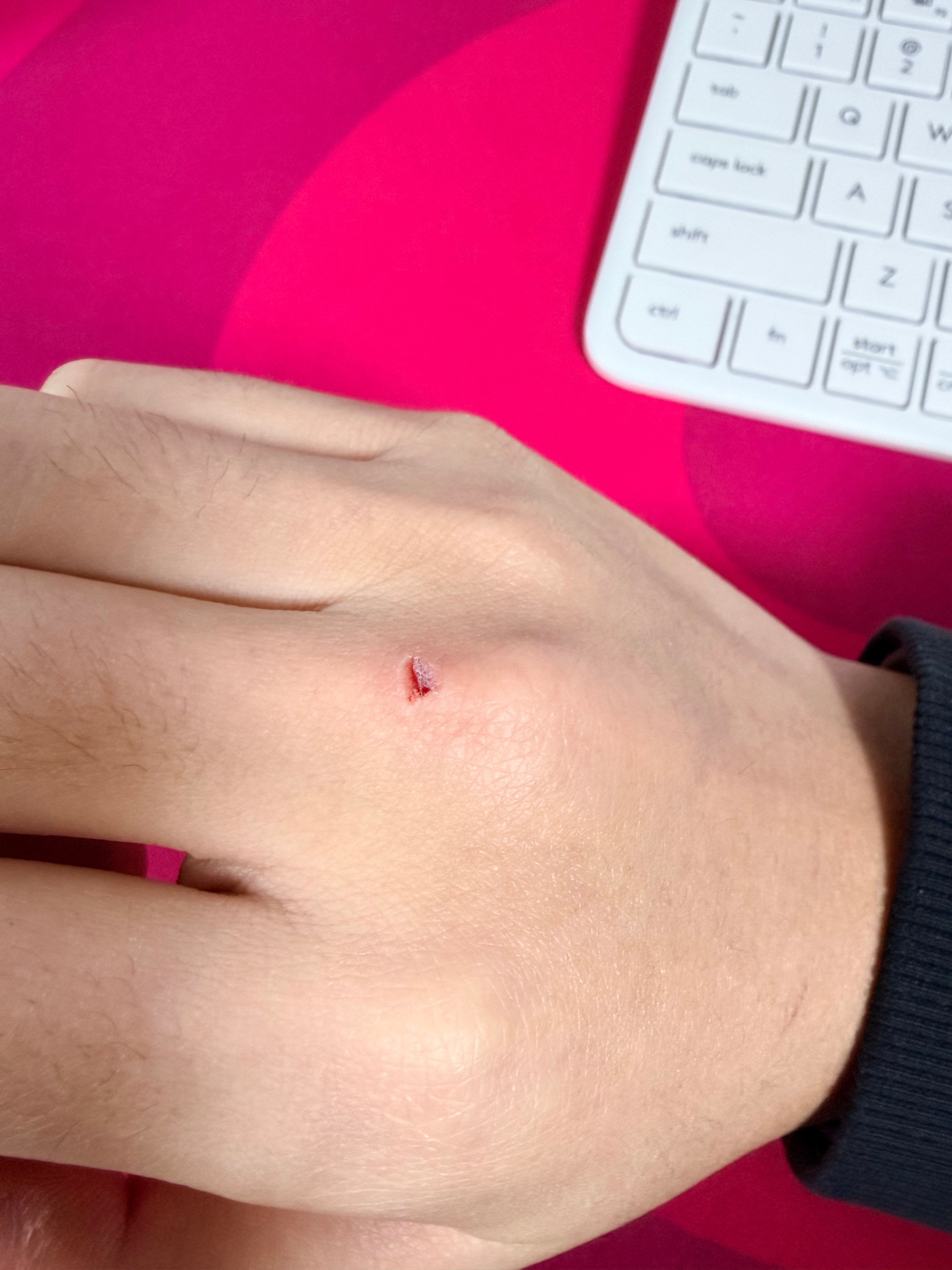 天冷了大家真的要小心点，小梦刚去拿了个快递回来发现手干破了，主要是没啥感觉