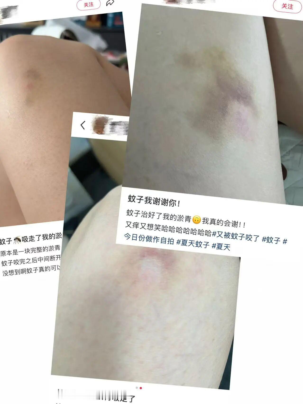 每天一条冷知识 网上所谓蚊子吸淤血，本质是蚊子包的过敏反应导致皮肤发白隆起，使用
