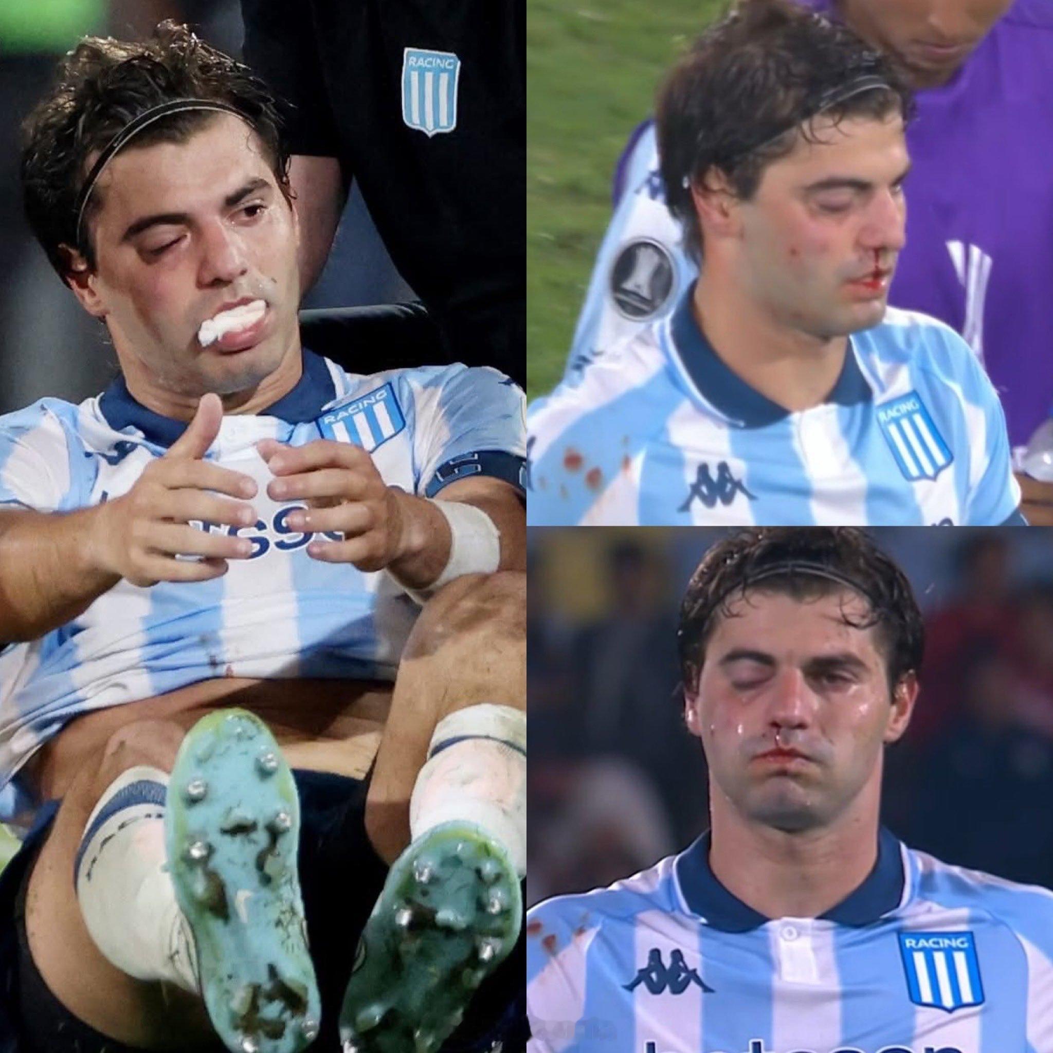 圣地亚哥·索萨右上颌窦骨折，将缺席南美解放者杯 竞技与弗拉门戈的第二回合。前河床