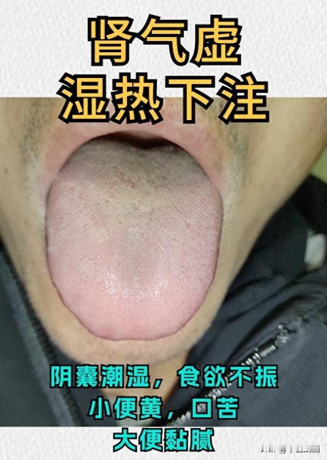 今天分析这两位朋友的舌象，大家看我分析的对不对？