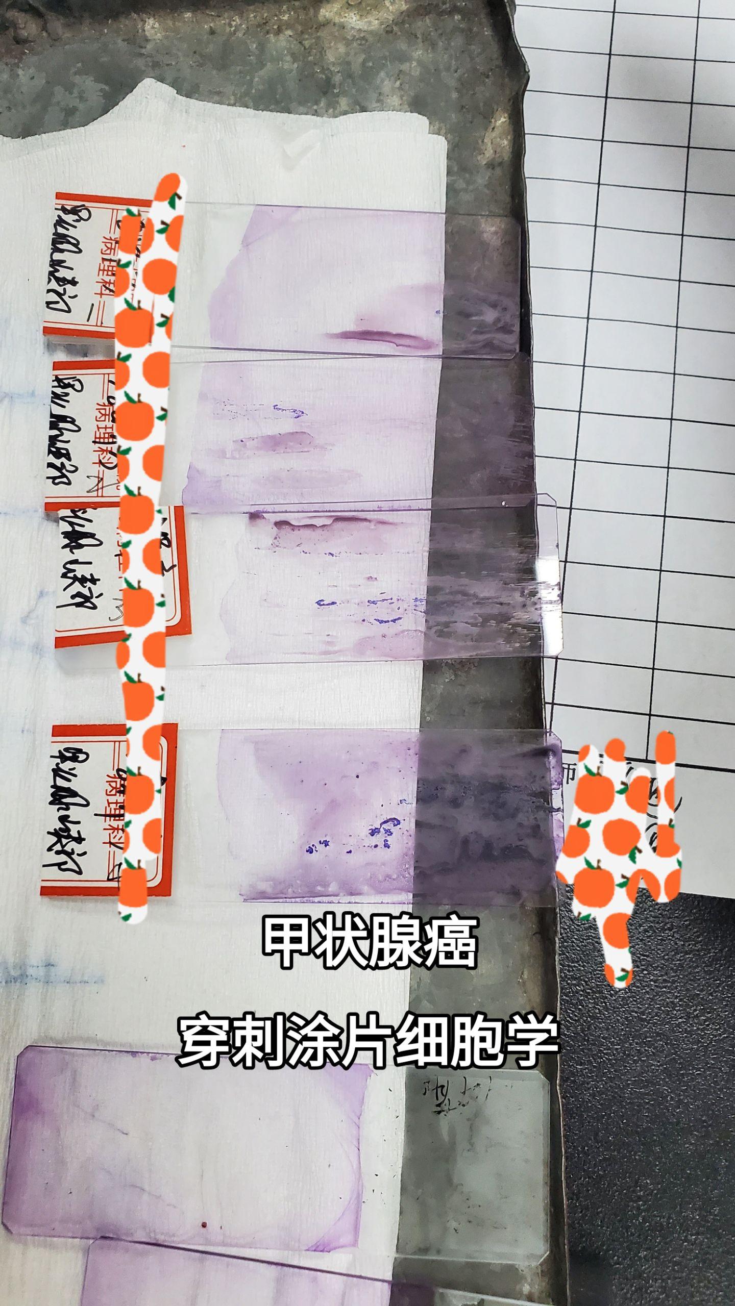 很典型的一个病例，这个医生穿刺水平高