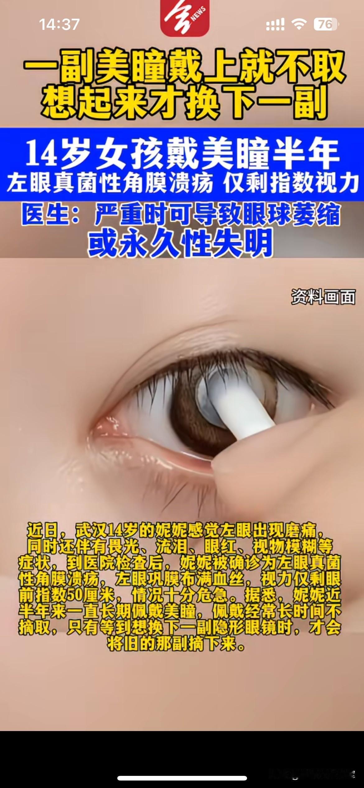 爱美乱戴美瞳，换来一场可怕的眼疾

武汉一名14岁女孩，长达半年都在错误佩戴美瞳