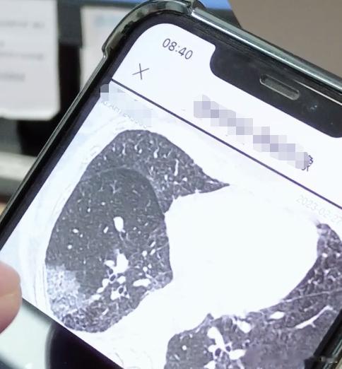 #乔贵宾的患者病例手册#在网上收到一位病友的咨询，在看完她的片子后，觉得十分不对