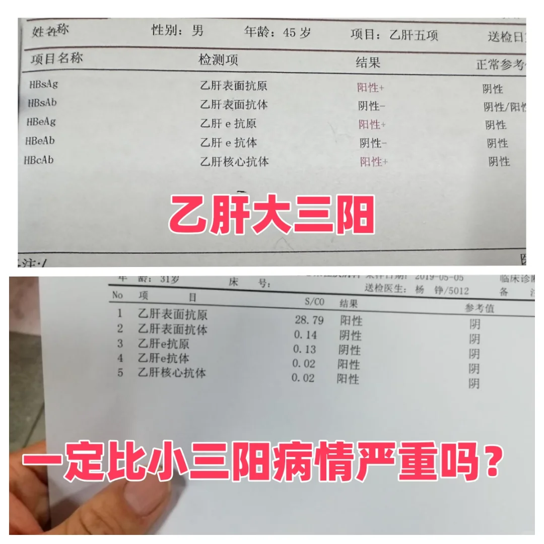 乙肝大三阳一定比小三阳病情严重吗？ 乙肝大三阳并不一定比小三阳病情严重...