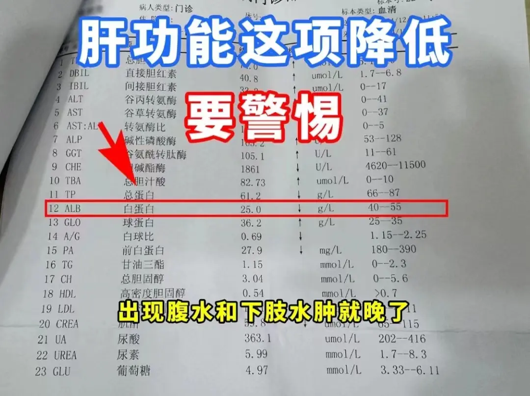 最近临床上接诊了位聊城的肝腹水患者，情况非常的危急，白蛋白降低到了25...