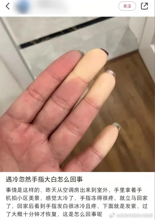 突然降温女生手指被冻成白色  如果突然出现霸总小说里脆弱女主的同款「指尖冻到发白