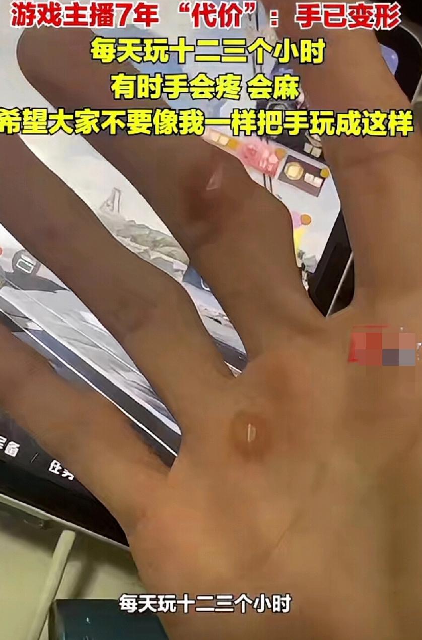 看着就疼！这是玩了七年手机游戏的手，不要因为孩子说游戏玩好了长大一样可以挣钱，就