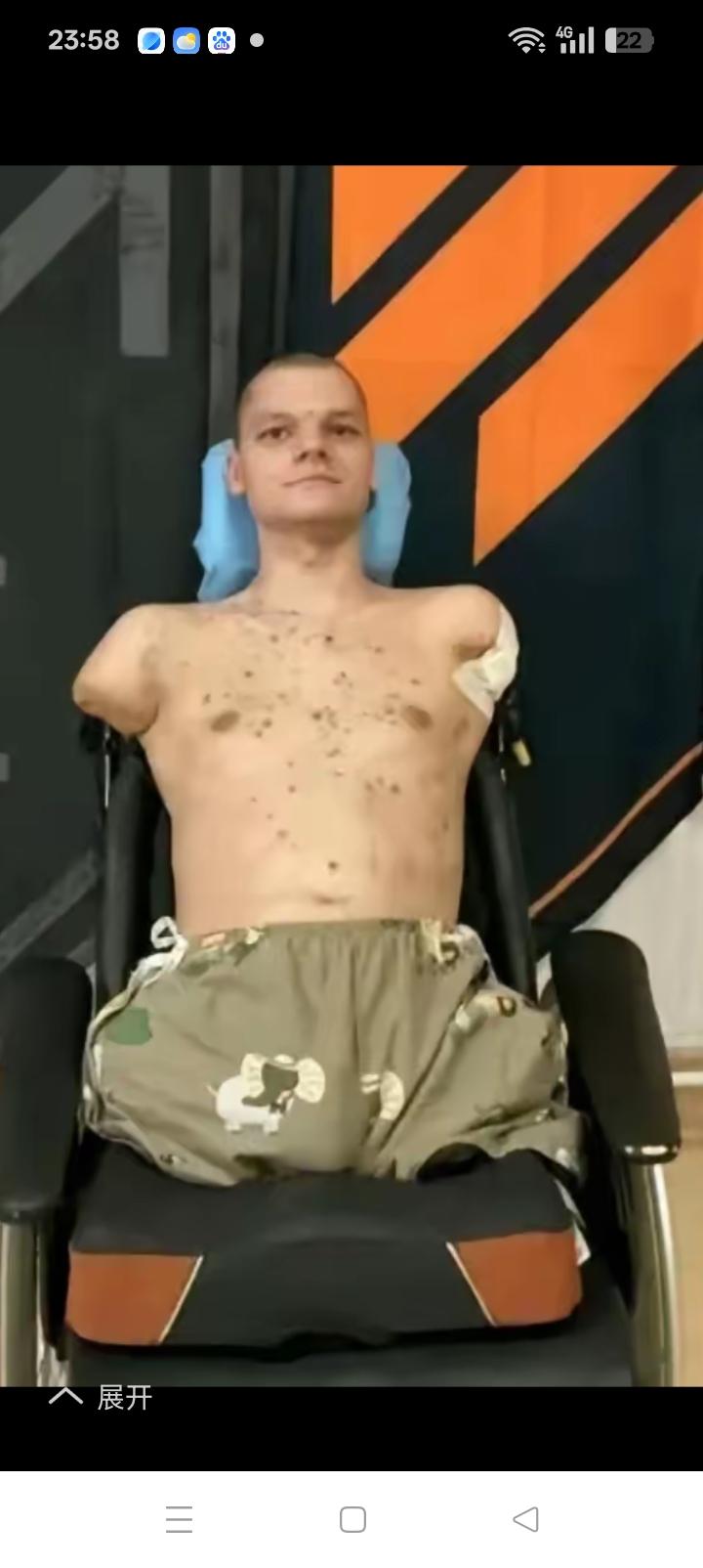 鼓吹战争的人，请看看这位幸存下来的乌克兰士兵。
三年俄乌战争，
双方死伤一百多万