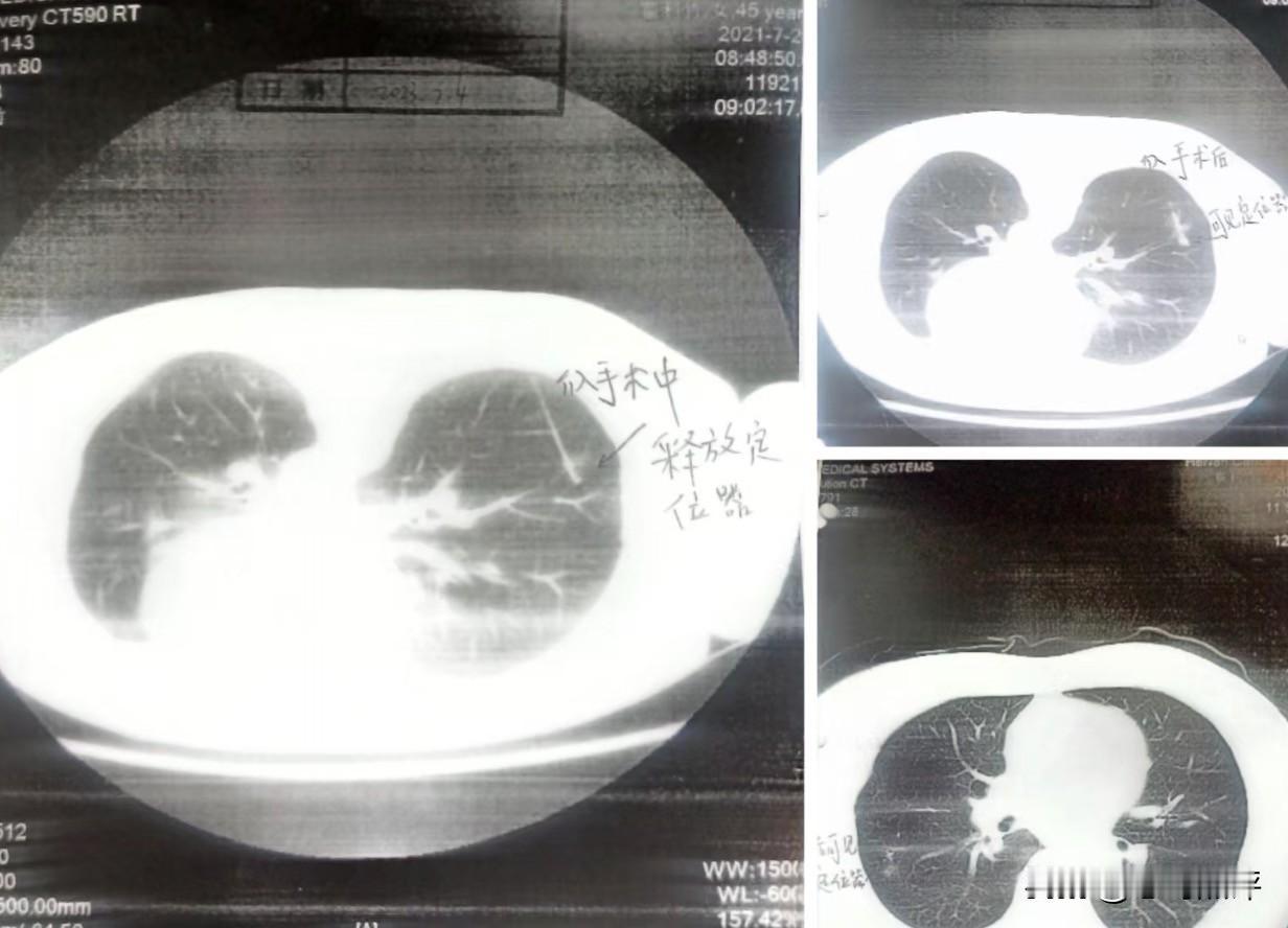 女子在医院做肺部结节切除手术，一年后去复查却发现，原本应该切除的结节还在，而且已