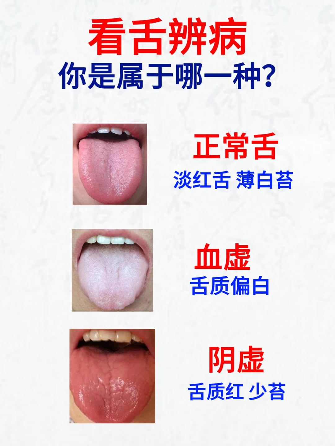 看舌辨病，9种常见舌象，看看你是属于哪一种情况？