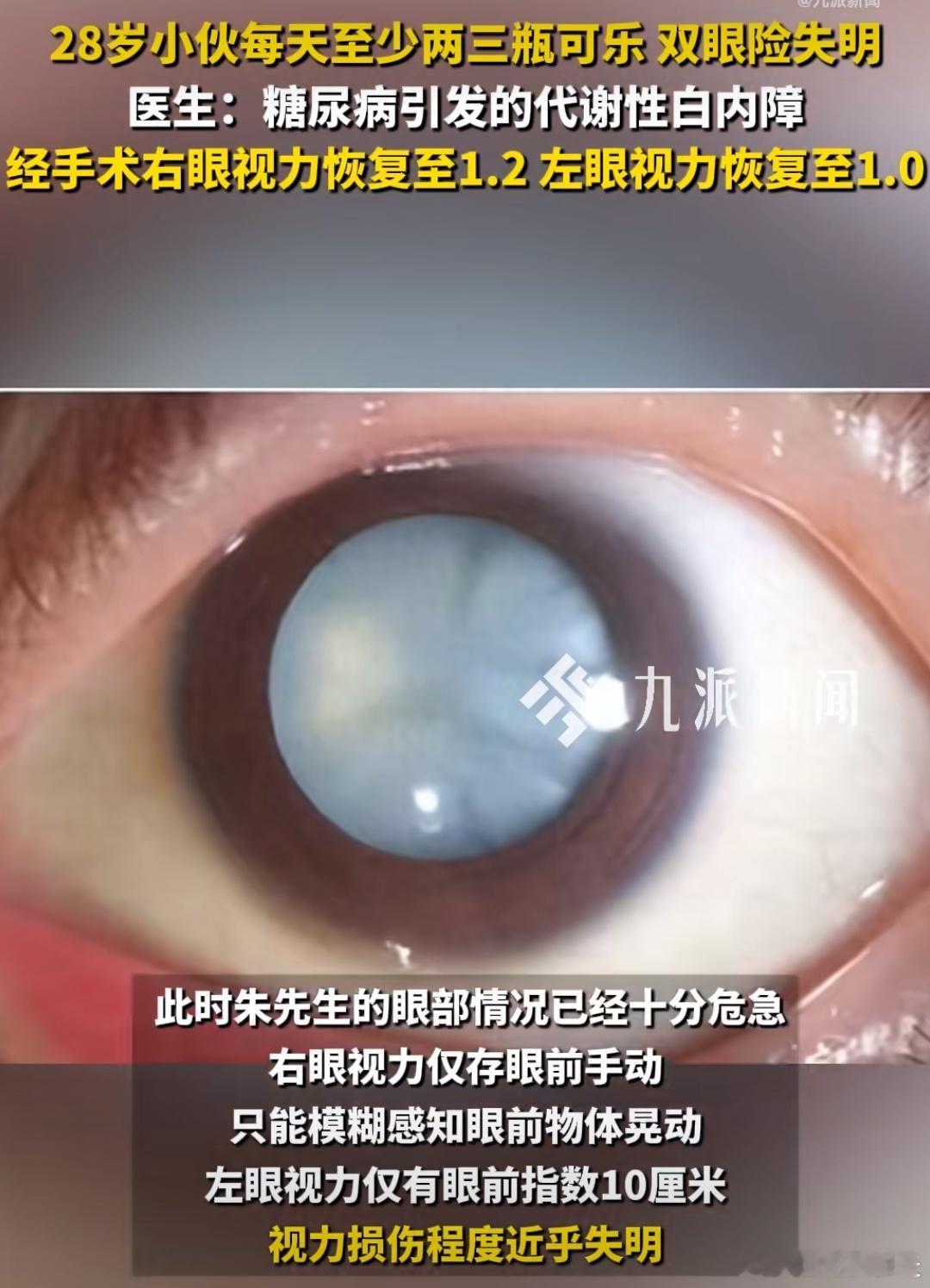 血糖高对视力的影响有多大血糖高对视力的影响有多大，对于很多人来说，根本看不到有多
