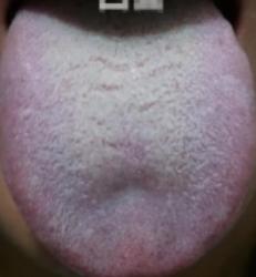 瓜蒌薤白半夏汤 专攻痰瘀互结老痰
大家好，我是中医陈大夫！
不少人咳嗽迁延不愈、