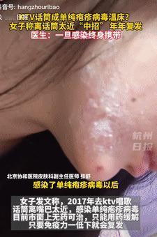 这是真吓人！4月14日浙江，一女子去KTV唱完歌后，嘴巴就感到很痒还起水泡，本以