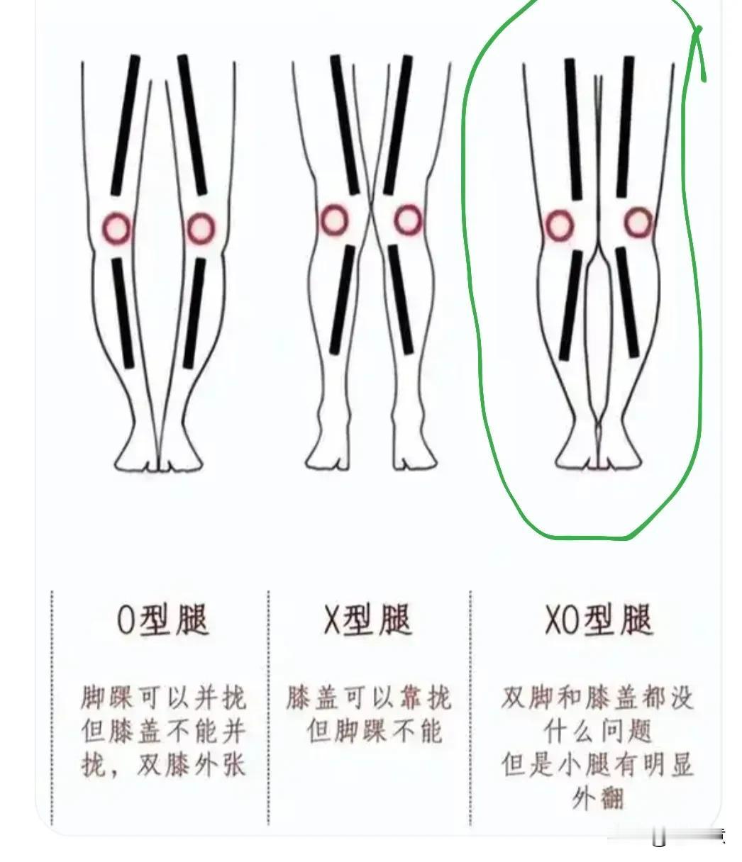 听说xo腿型可多，真的吗[what]