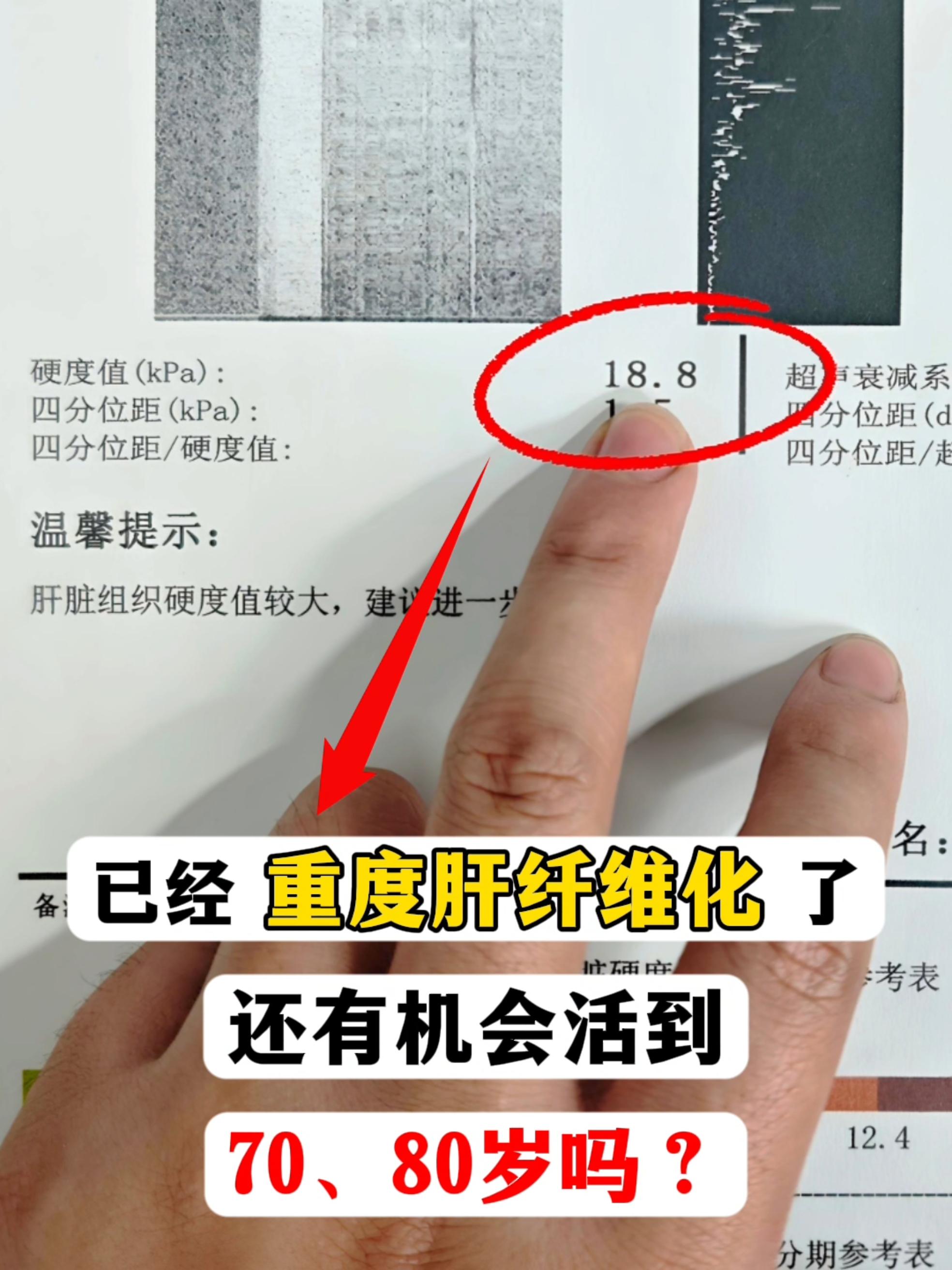“叫你早点来医院检查，你就一直拖，现在肝疼了、眼睛黄得和橘子皮一样，知...