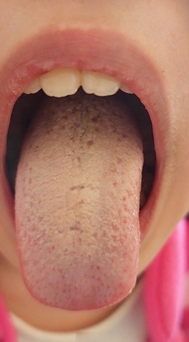 女 九岁 北京一周前检测腺病毒，高烧两天低烧四天至今，晚上睡眠不咳嗽，但睡前和早