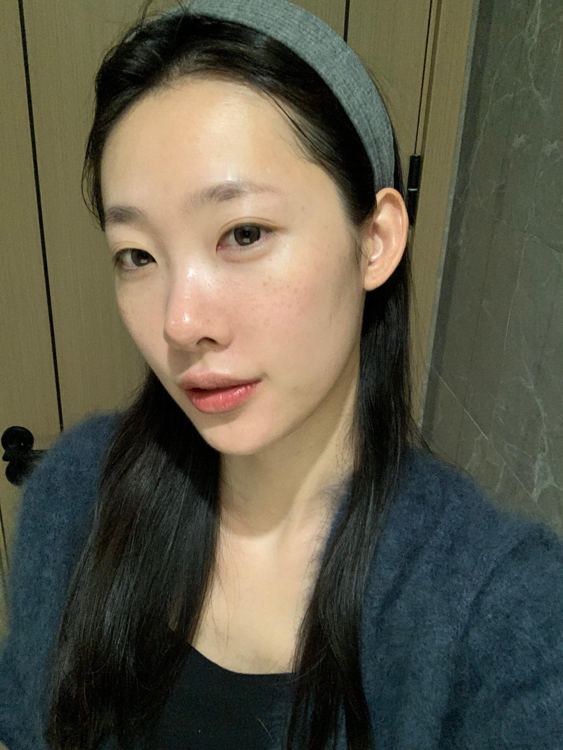 好的 再次相信科技的力量时隔半年做的光电项目onda 做完维护一周的效果 提拉完