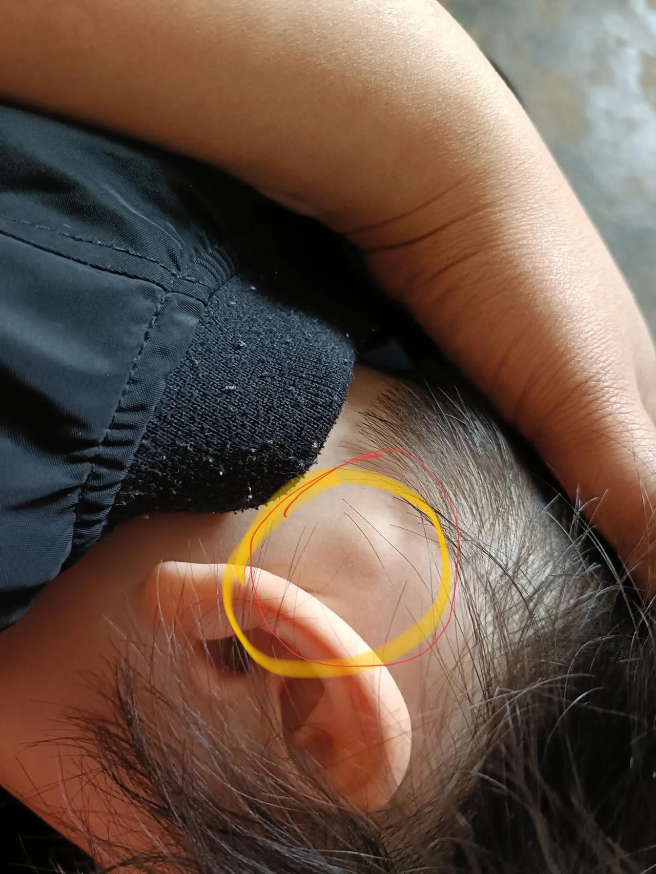 有没有人知道这是什么啊？我家2岁女儿脖子后面长了一个小鼓包，大概一个周之前我发现