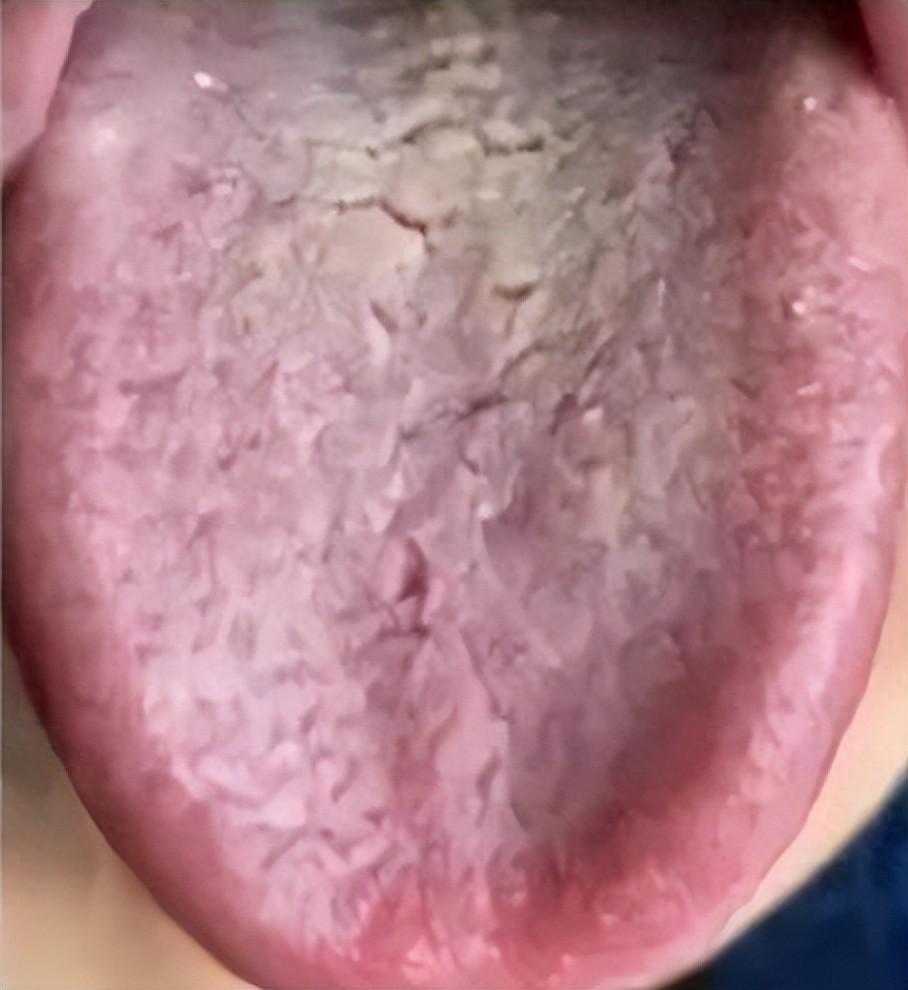 关于舌头的四个“重中之重”，千万不要忽视！
（1）舌边鼓胀
舌头两边鼓胀，说明有