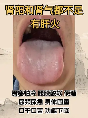 专门抽时间来看舌苔，今天是挑战舌诊的15天了，你发我就看！ 1.痰湿化...