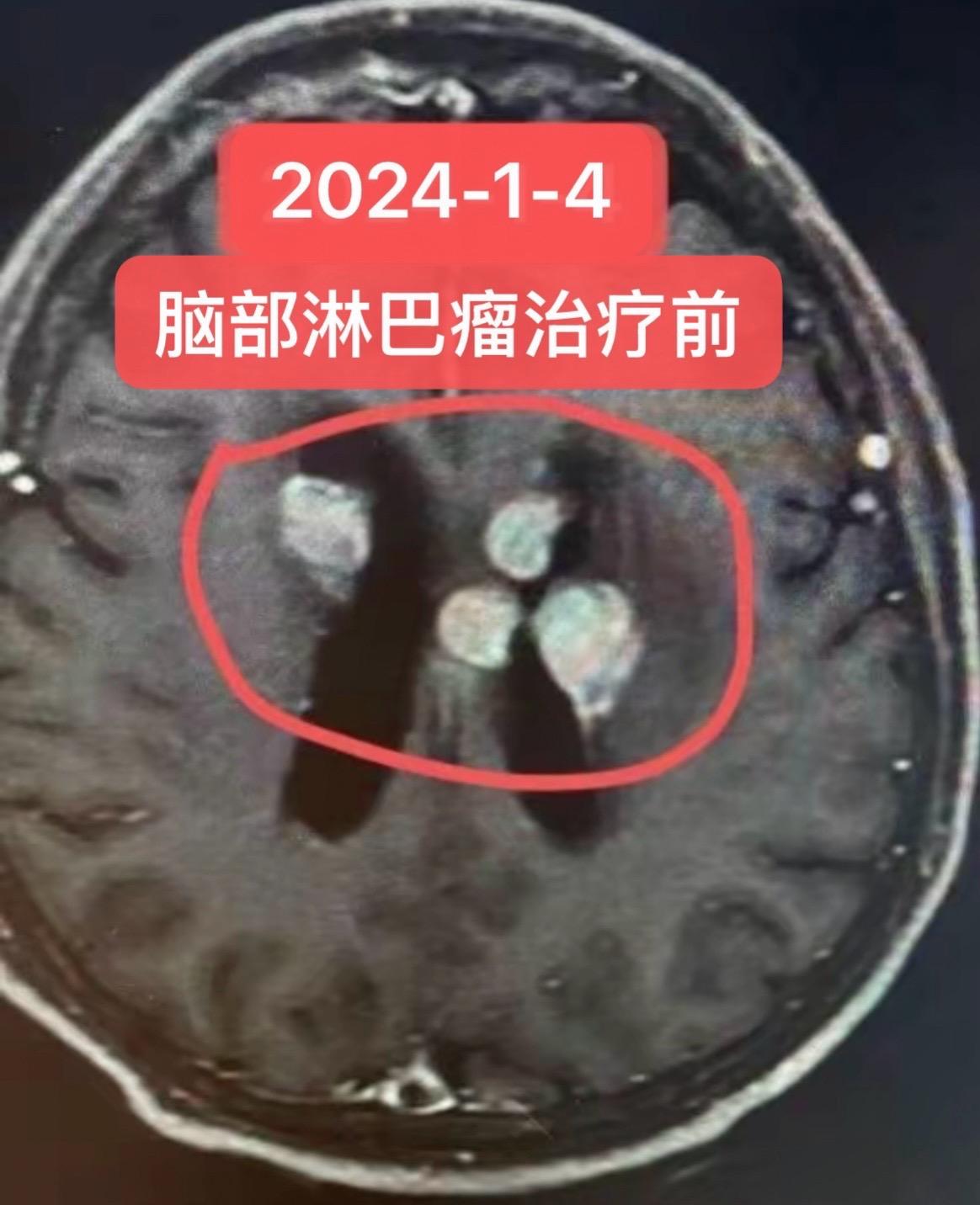 脑部淋巴瘤挽救治疗一例经验分享。脑部淋巴瘤治疗经验分享 患者女，63岁...