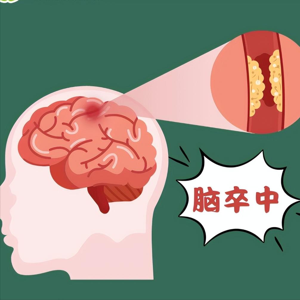 脑出血失语，90%家属在帮倒忙！3阶段做对，让家人重新开口

第一阶段是发病后的