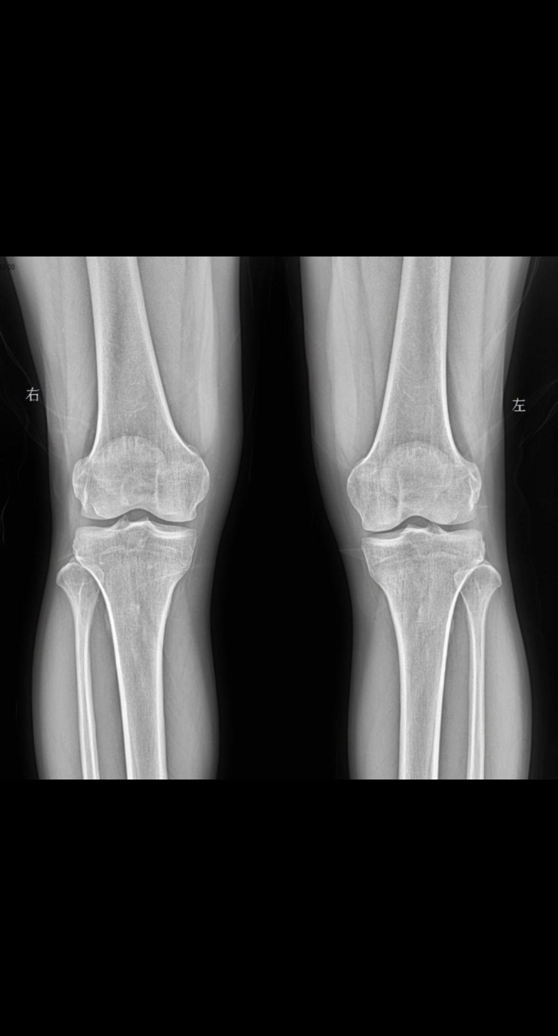 主诉 患者右侧膝盖疼痛 男47
