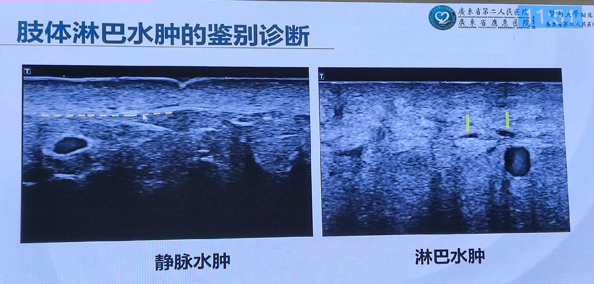 淋巴管超声。淋巴水肿与静脉血栓水肿鉴别