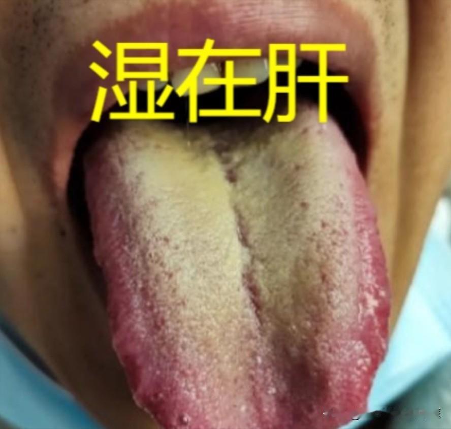 肝湿——阴囊潮湿，脾湿——体力差，肾湿——疲软无力，一个药，祛你全身湿！！！
