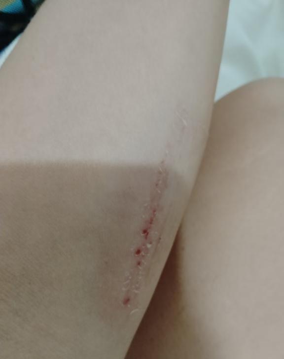 差不多恢复了，应该明天就可以锻炼