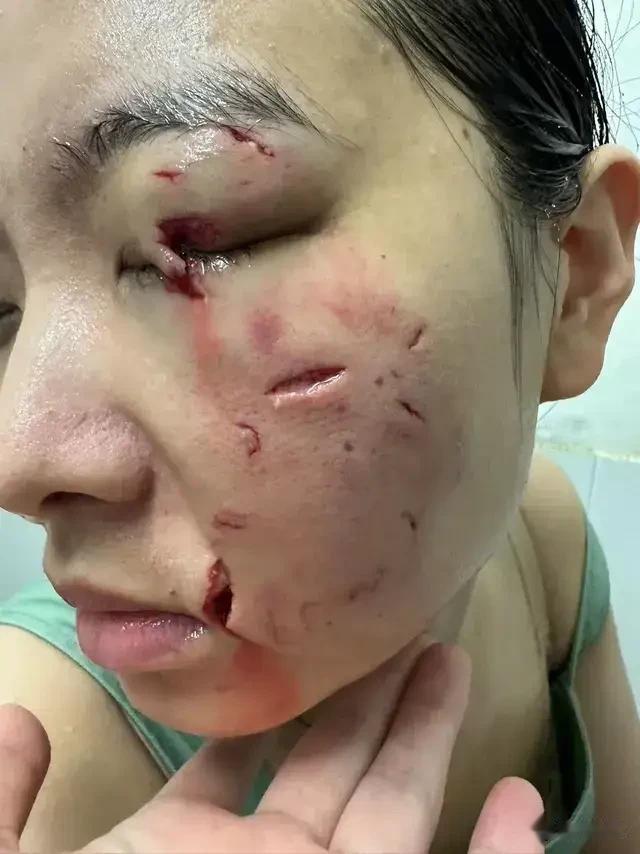 美女被狗狗直接撕咬脸部，10几处伤口，破相了，心也碎了。

估计她也是爱狗人士，