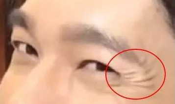 奸门（外眼角至太阳穴中间这块地方）发炸，又叫奸门开花。年纪轻轻就在奸门长又多又深