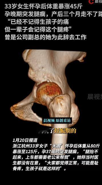 杭州有位33岁的准妈妈“大圆”在网上引发了热议。她怀孕后体重从80斤飙升到125
