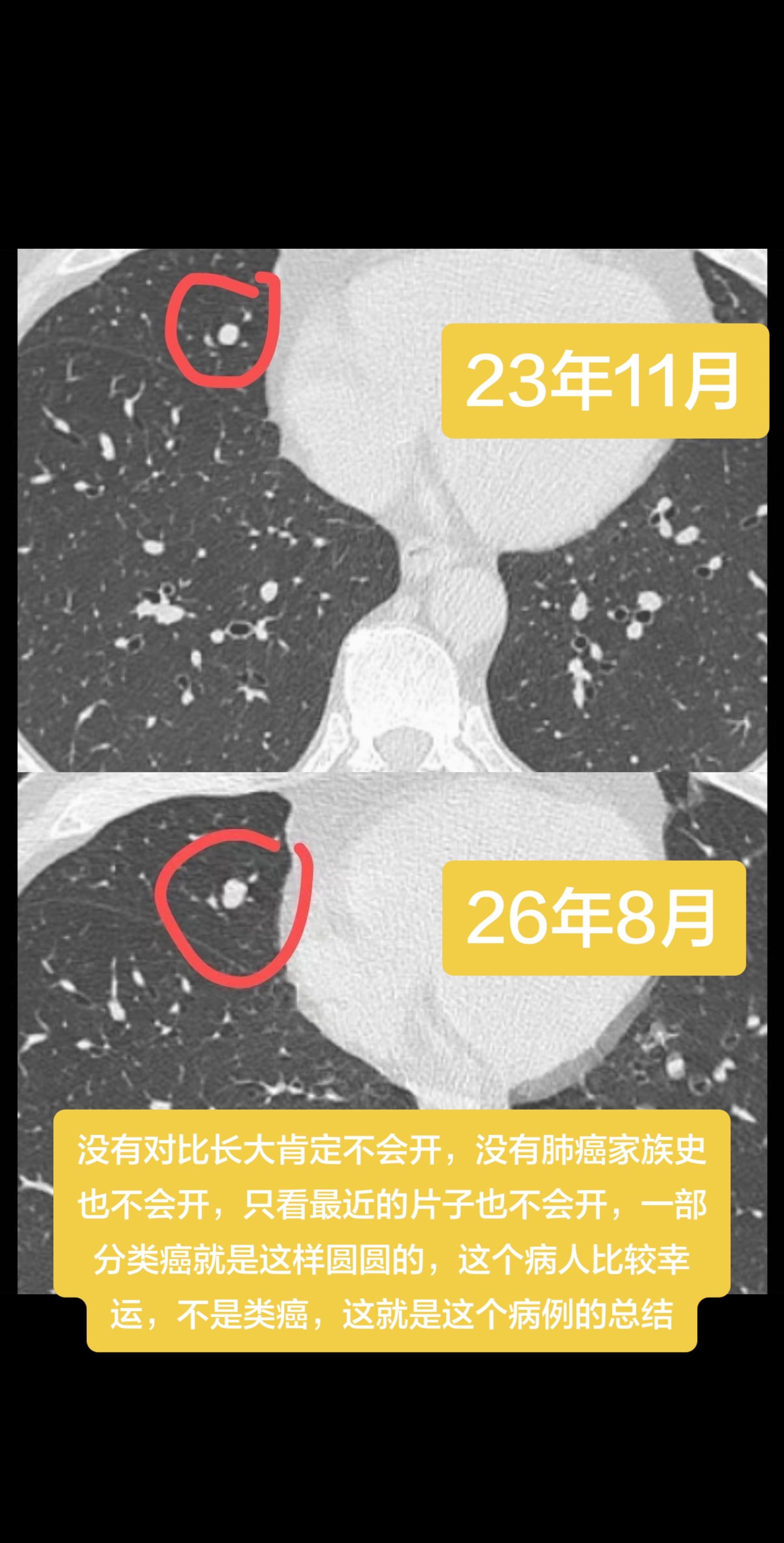 没有对比长大肯定不会开，没有肺癌家族史也不会开，只看最近的片子也不会开...