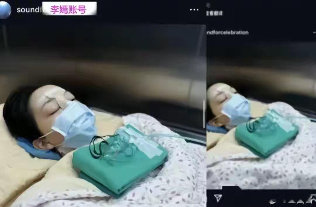 #李嫣晒唇腭裂手术照#产检时就发现了是兔唇，但是妈妈王菲执意生下来，因为有信心和