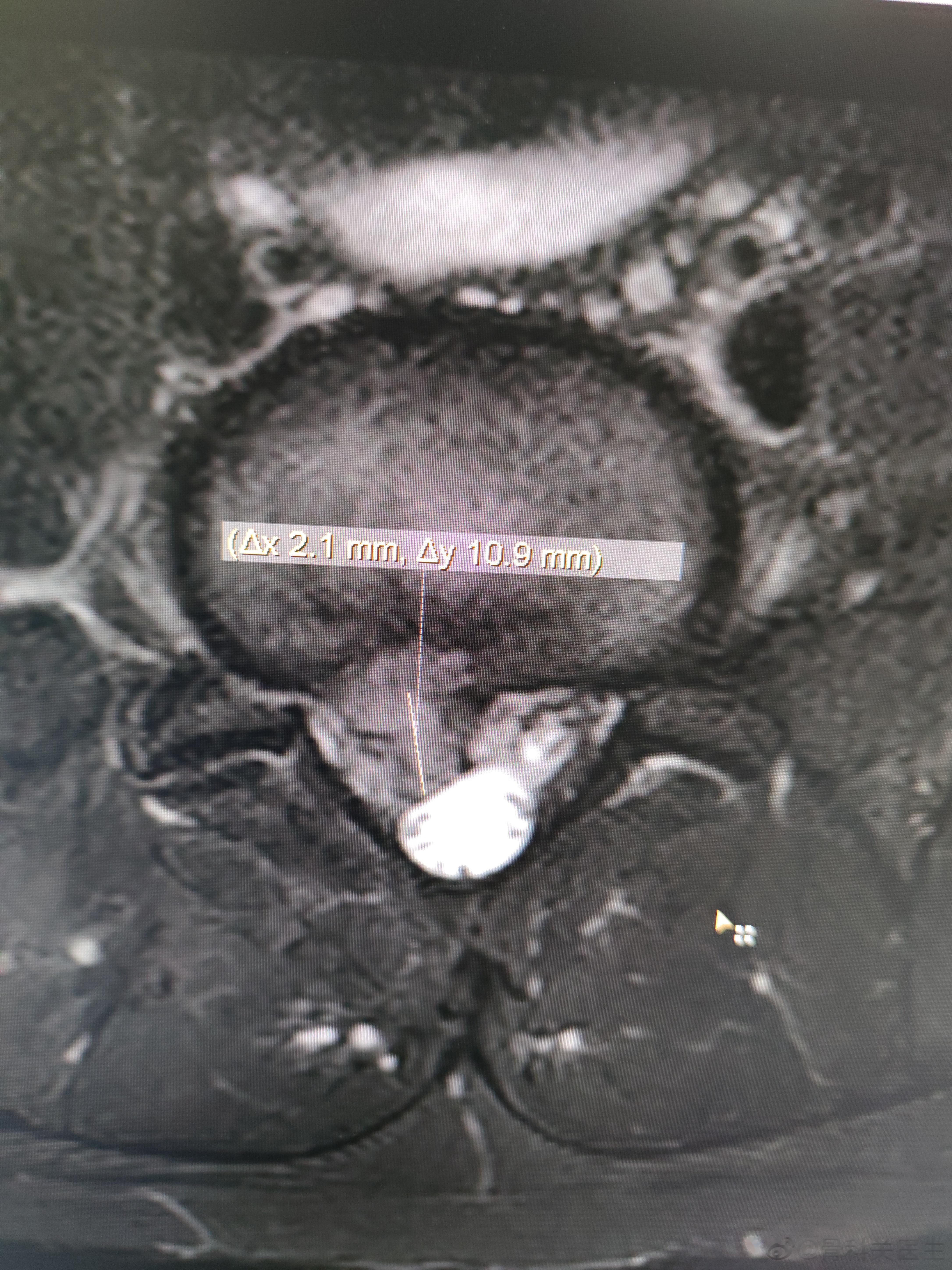 忙里偷闲的脊柱内镜手术，病人是医院的同事。我们把微创做到了极致，没有上尿管，没有