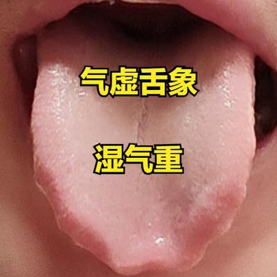 湿气——气虚，失眠多梦——血虚，手脚不温怕冷——阳虚
 
 
①湿气——气虚
 