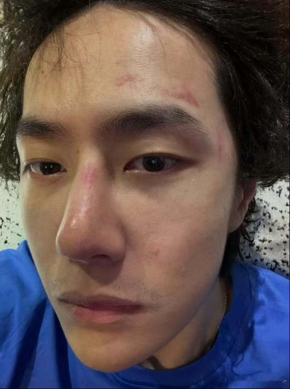 王一博ins素颜自拍王一博晒伤都愿意和大家分享，最不需要美颜磨皮滤镜修图，最不怕