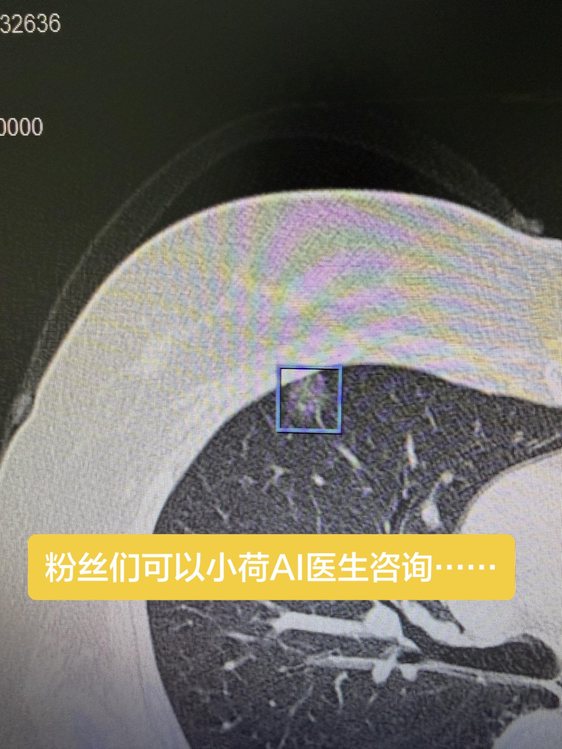 粉丝们可以小荷Ai医生咨询……