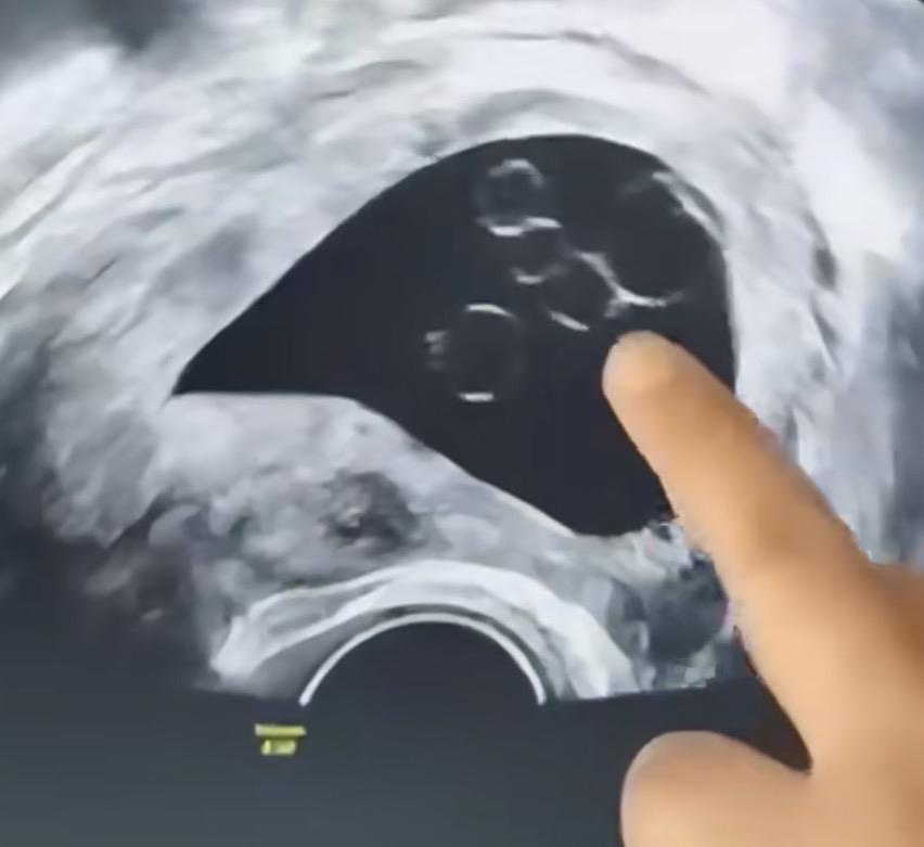 备孕乱吃“多子丸”，怀上四胞胎险酿大祸⬇️近日，江苏淮安李女士因备孕困难，自行在