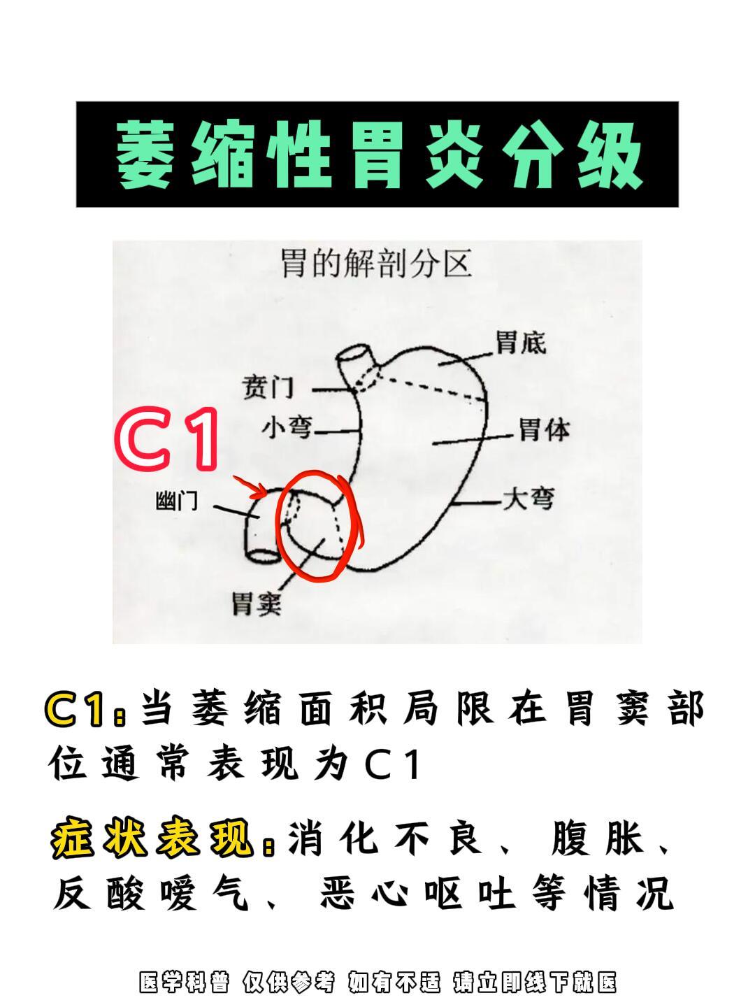 萎缩性胃炎分级﻿。 