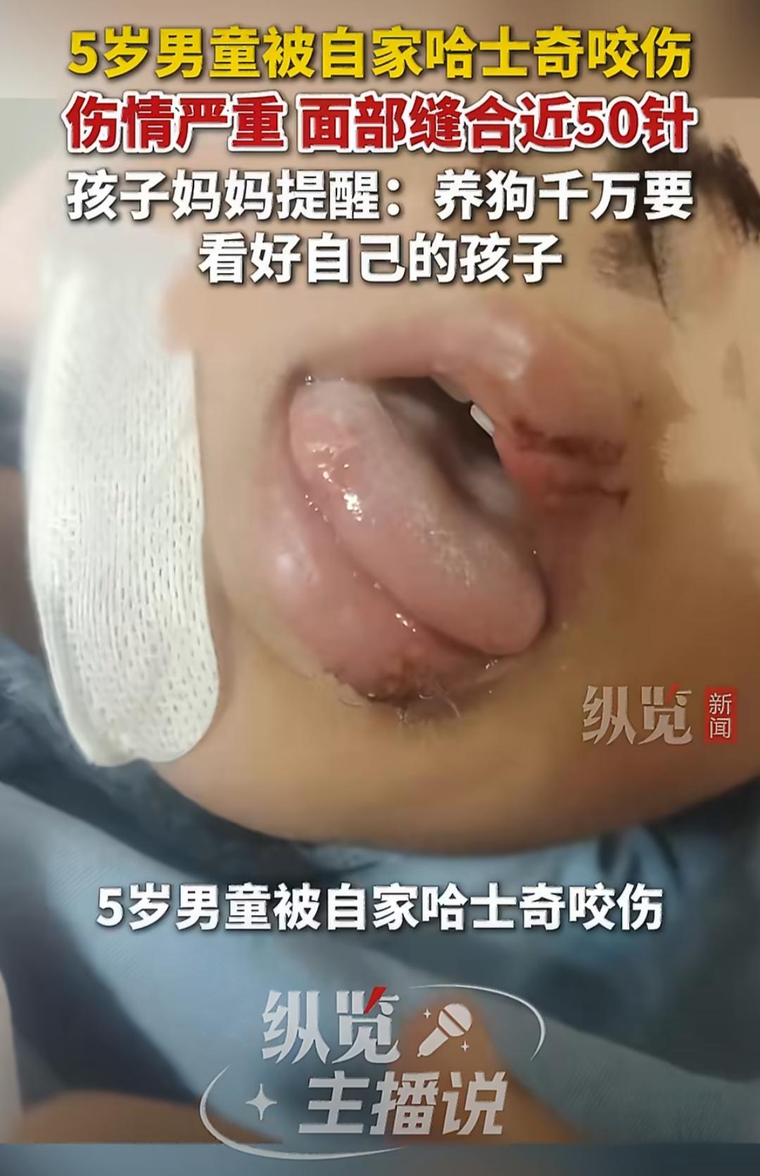 江苏徐州有个5岁的小男孩，被自家养了好几年的哈士奇咬伤了，伤得还挺严重，脸上缝了