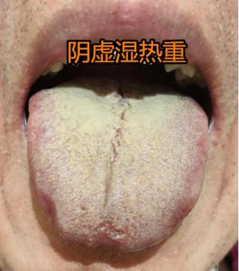 看看这个舌头，舌苔厚腻的都快能揭下来了，唇舌生疮还有溃疡。
 
患者情况：房市欠