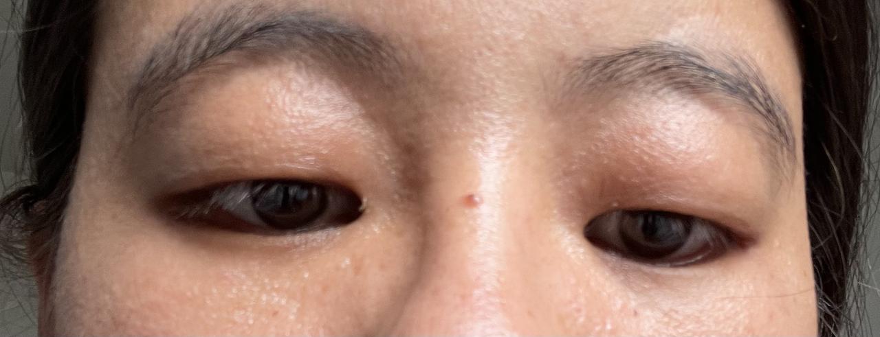 两只眼睛的黑眼圈又黑又圆，我看到的时候吓了一跳。
我妈妈说她胃不舒服夜里睡不着觉