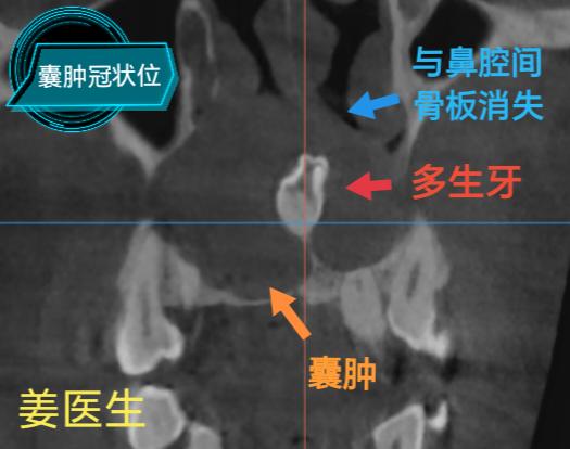 囊肿术后种植修复。患者“含牙囊肿”，范围15-23，累及8个牙位，前牙...