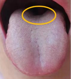 看完舌根就知道男人房市的好坏了，舌根主肾，肾阳不足就会凹陷下去，像这种很明显的舌