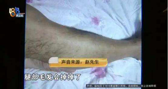 浙江诸暨，男子开新能源车1年，突然发现自己两条腿上原本茂密的毛发，竟然都掉秃了，
