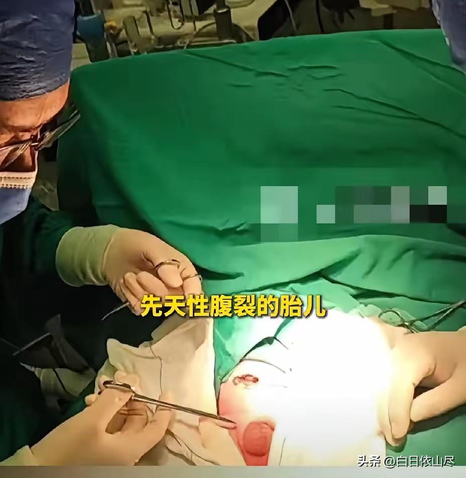 生命的奇迹！2月25日，河南郑州一孕妇生下一位先天性腹裂婴儿，胃肠道等器官暴露在