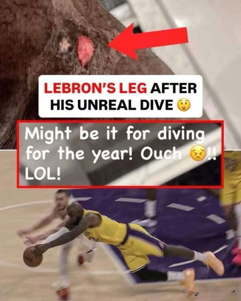 詹GOAT晒伤口求安慰？
昨天湖人恶战苦主掘金，詹姆斯难得拼尽全力，奉献了一次鱼