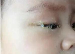 孩子眼屎多、眼屎黄怎么办？
 
当孩子出现眼屎多、眼屎黄，并排除结膜炎、沙眼、用
